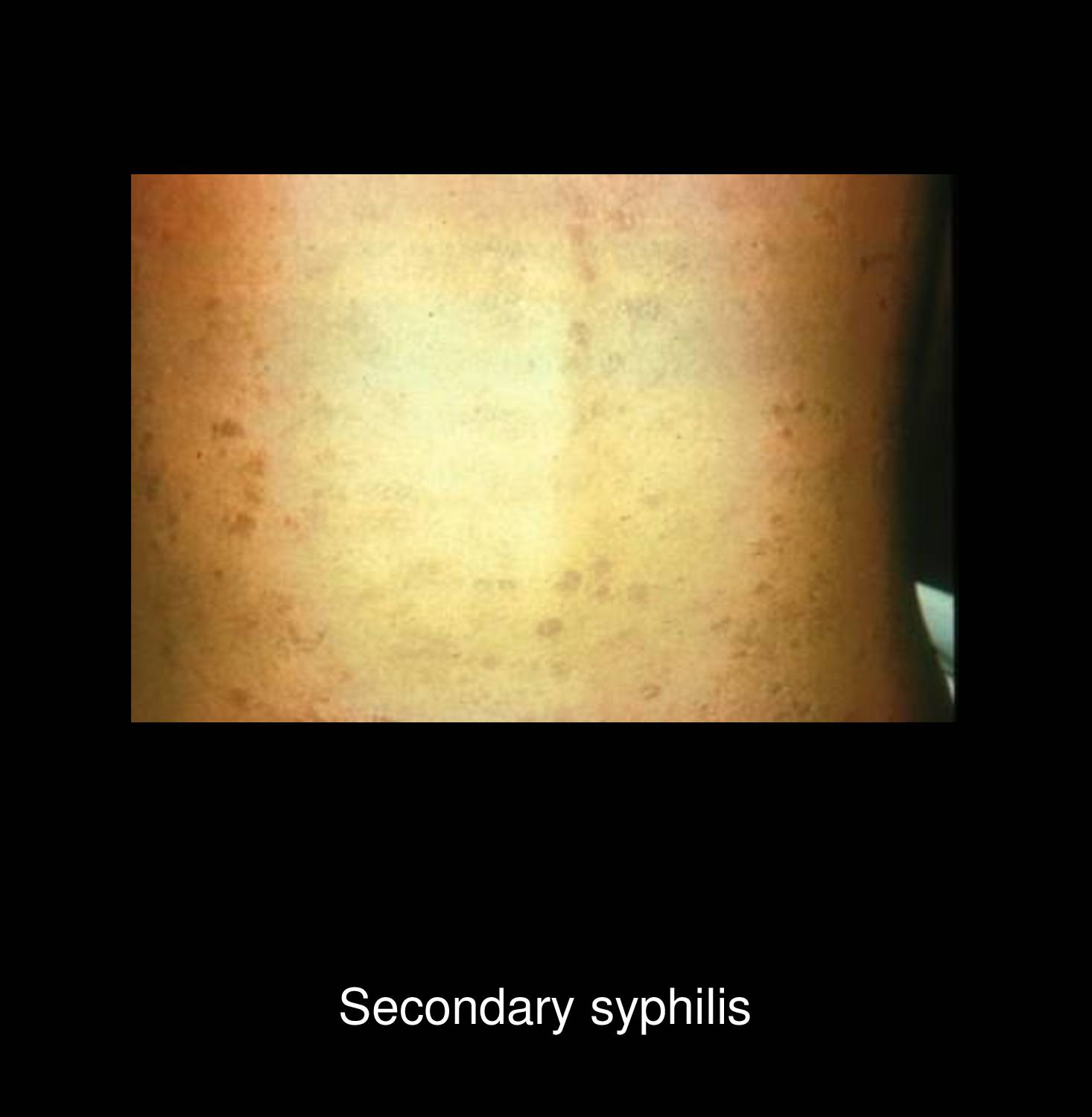Secondary syphilis annular papular rash on penis showing ring-shaped papulosquamous lesions with central clearing typical of Treponema pallidum infection